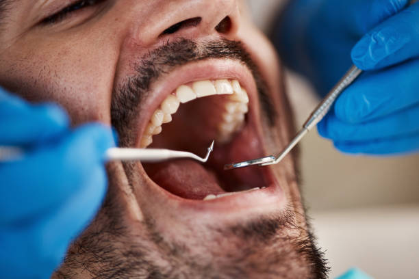 Best Emergency Dental Extractions in Mountain View, HI